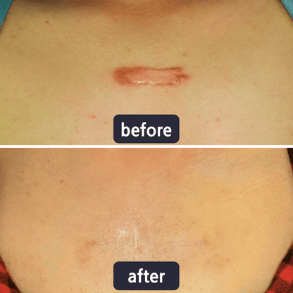 Quickly Fade New and Old Scars & Tighten Skin Repair Cream | Safe, Gentle & Suitable for Sensitive Skin