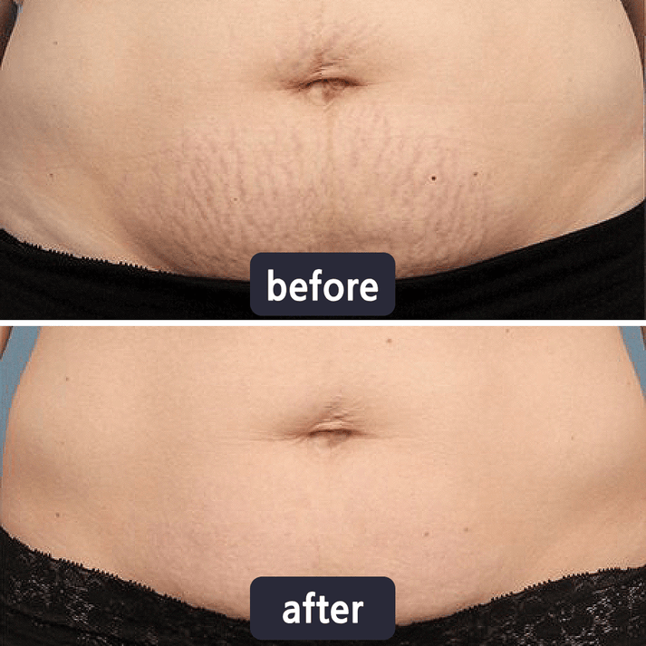Quickly Fade New and Old Scars & Tighten Skin Repair Cream | Safe, Gentle & Suitable for Sensitive Skin